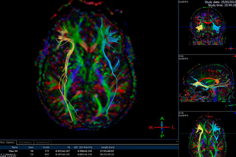 The Neural Basis for Creativity